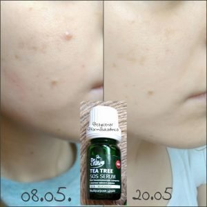 serum sos trị mụn tea tree review của khách hàng khi sử dụng