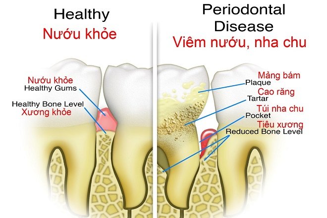 Nếu không có biện pháp chăm sóc đúng cách, rất dễ để răng bạn bị viêm nha chu
