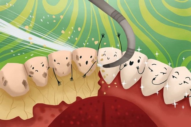 Việc lấy cao răng chỉ khiến bạn cảm thấy hơi ê buốt chứ không làm đau
