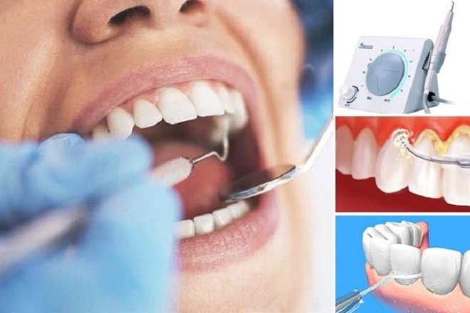 Lấy cao răng định kì để đảm bảo sức khỏe răng miệng