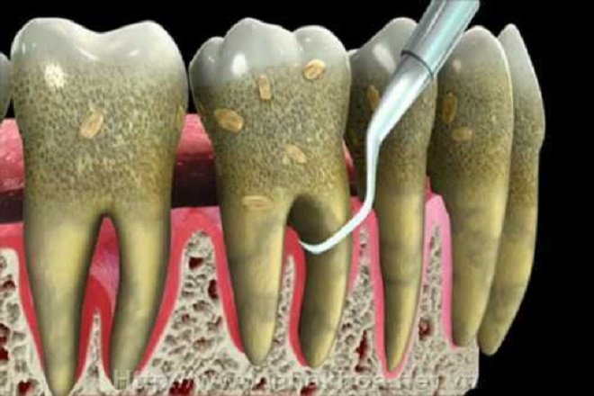 Cao răng hình thành từ thức ăn thừa và sự tích tụ của các vi khuẩn