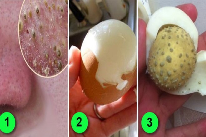 Sử dụng trứng gà luộc để hút mụn đầu đen   Biện pháp an toàn, đơn giản, tiết kiệm