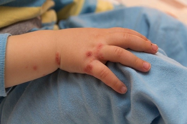 Cách chăm sóc trẻ bị tay chân miệng tại nhà để bệnh nhanh khỏi tránh những biến chứng nguy hiểm