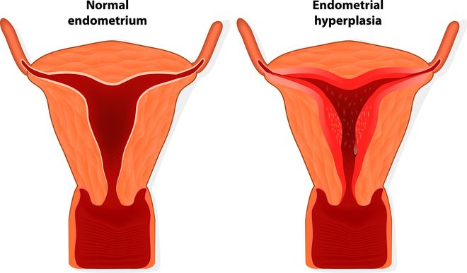 Độ dày, mỏng của nội mạc tử cung cũng ảnh hưởng đến khả năng sinh sản của nữ giới