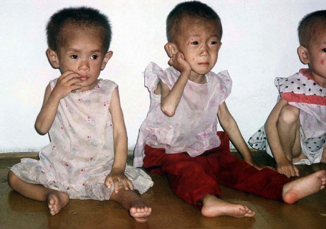Vấn đề suy dinh dưỡng ở trẻ em Việt Nam xuất phát từ nguyên nhân nào và cách phòng tránh như thế nào?