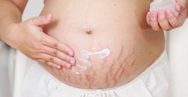 Rạn da của phụ nữ mang thai
