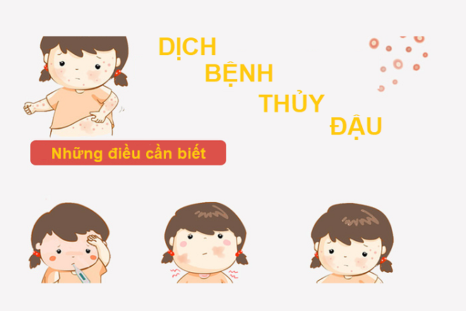 Dịch bệnh thủy đậu