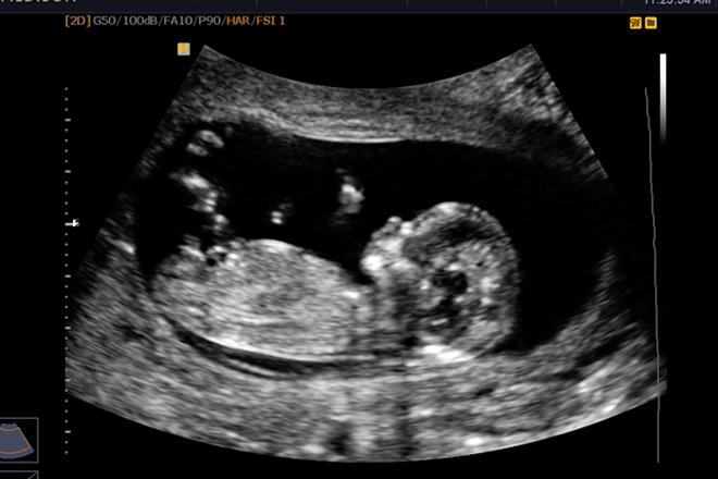 Hình ảnh thai nhi 12 tuần Những hình ảnh đầu tiên của bé rất quan trọng và đầy cảm xúc. Với siêu âm 4D thai nhi 12 tuần, bạn sẽ được trải nghiệm cảm giác tuyệt vời khi xem bé yêu của mình chuyển động và nhún nhảy trong bụng mẹ. Xem ngay để có những khoảnh khắc ngọt ngào!