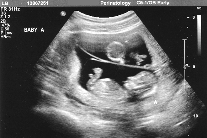 Hãy xem hình ảnh thai nhi 12 tuần đáng yêu này, bạn sẽ được khám phá một chút về quá trình phát triển của bé của mình. Bạn sẽ bị níu chân với những đoạn video rõ ràng và chân thật, cho thấy cơn động kinh hạch, sự chuyển động và những phản ứng đáng yêu của bé.