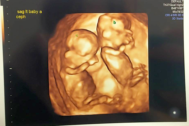 Hãy cùng chiêm ngưỡng những khoảnh khắc kỳ diệu của siêu âm thai 12 tuần, để cảm nhận sự trưởng thành từng ngày của đứa bé trong bụng mẹ. Từ sự phát triển đáng kinh ngạc đến ánh mắt thính lực đầu tiên của đứa bé, bạn sẽ tìm thấy nhiều điều thú vị và đáng yêu trong những hình ảnh này.