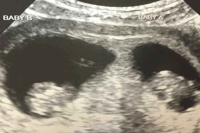 Với hình ảnh siêu âm thai nhi 12 tuần, bạn sẽ được ngắm nhìn những chi tiết rõ nét về cơ thể và khuôn mặt của con yêu ngay từ thời kỳ đầu tiên.