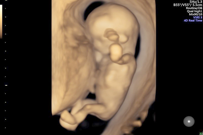 15 hình ảnh thai nhi 12 tuần tuổi - Siêu âm thai Bạn đang mong đợi một đứa con và bạn muốn xem những hình ảnh đầu tiên của thai nhi của mình? Với siêu âm thai, bạn có thể theo dõi các hình ảnh thai nhi 12 tuần tuổi rõ nét nhất. Ngắm nhìn những hình ảnh đáng yêu của thai nhi của bạn và cảm nhận tình mẫu tử đầy xúc động.