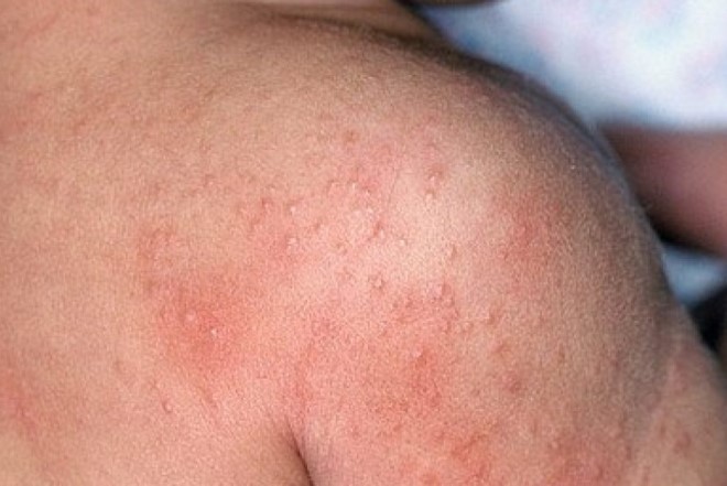 Bệnh viêm da ở trẻ sơ sinh – Ba mẹ không nên coi thường