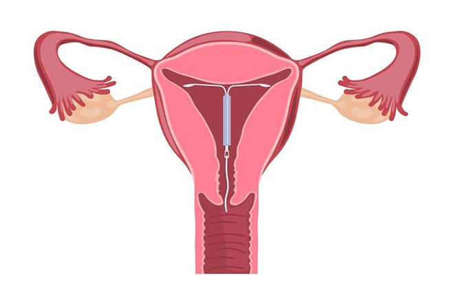 Đặt vòng tránh thai sau sinh cần lưu ý những gì?