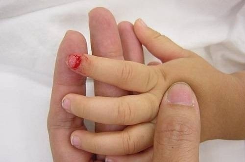 4 bước xử lý khi trẻ bị gãy ngón tay, ngón chân để nhanh chóng giảm đau và cầm máu