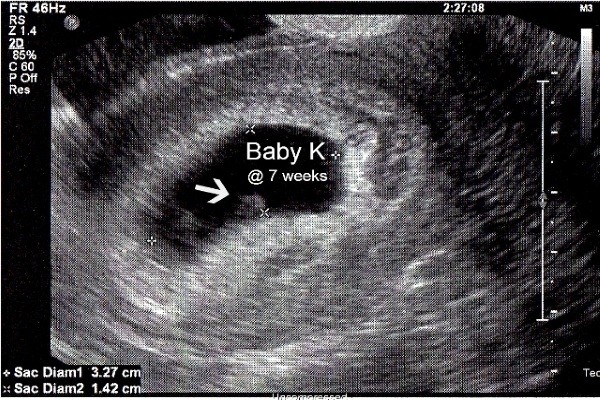 Thai nhi 6 tuần tuổi đã có tim thai chưa, các mẹ nào hồi hộp thì vào đây xem nhé!